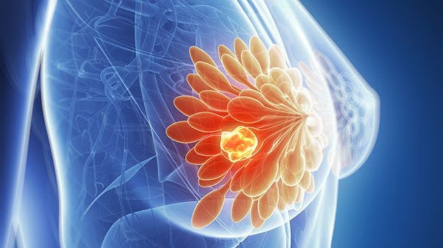 Olaparib Improves Survival in BRCA+, High-Risk Early Breast Cancer