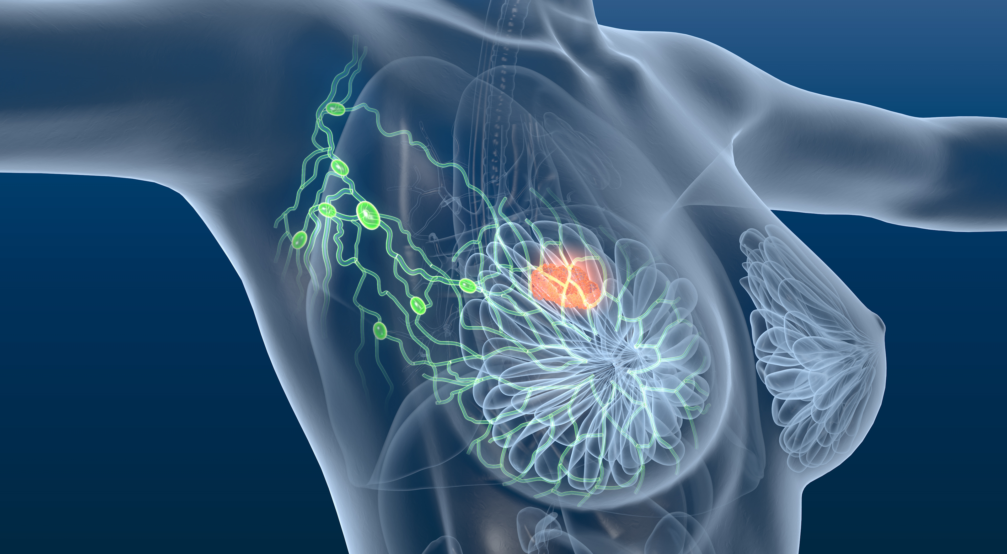 Patients With HR+/HER2- Advanced Breast Cancer May Reduce Ribociclib Dose Without Jeopardizing Outcomes