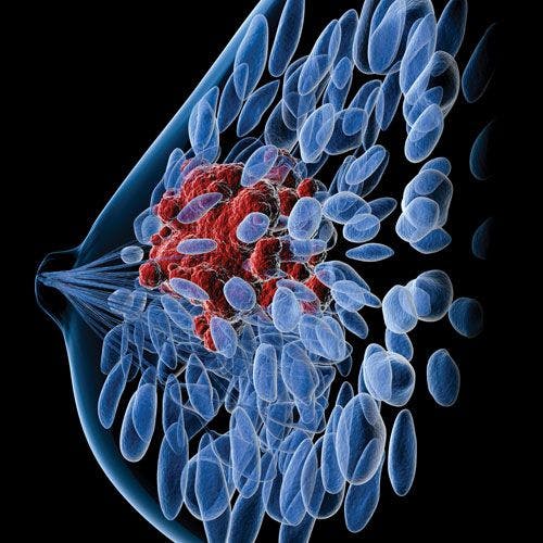 In Low-Risk Breast Cancer, Less Treatment May Be Better
