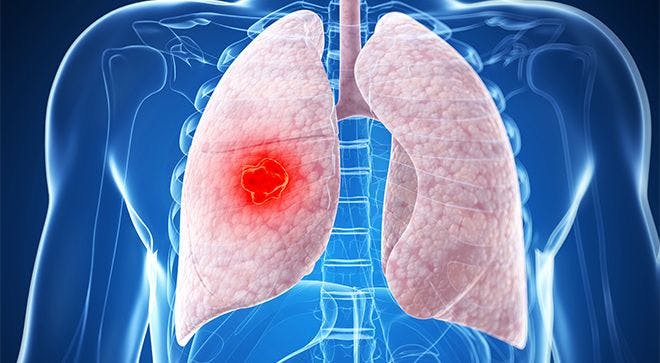 Atezolizumab Improves Survival in Extensive-Stage Small Cell Lung Cancer