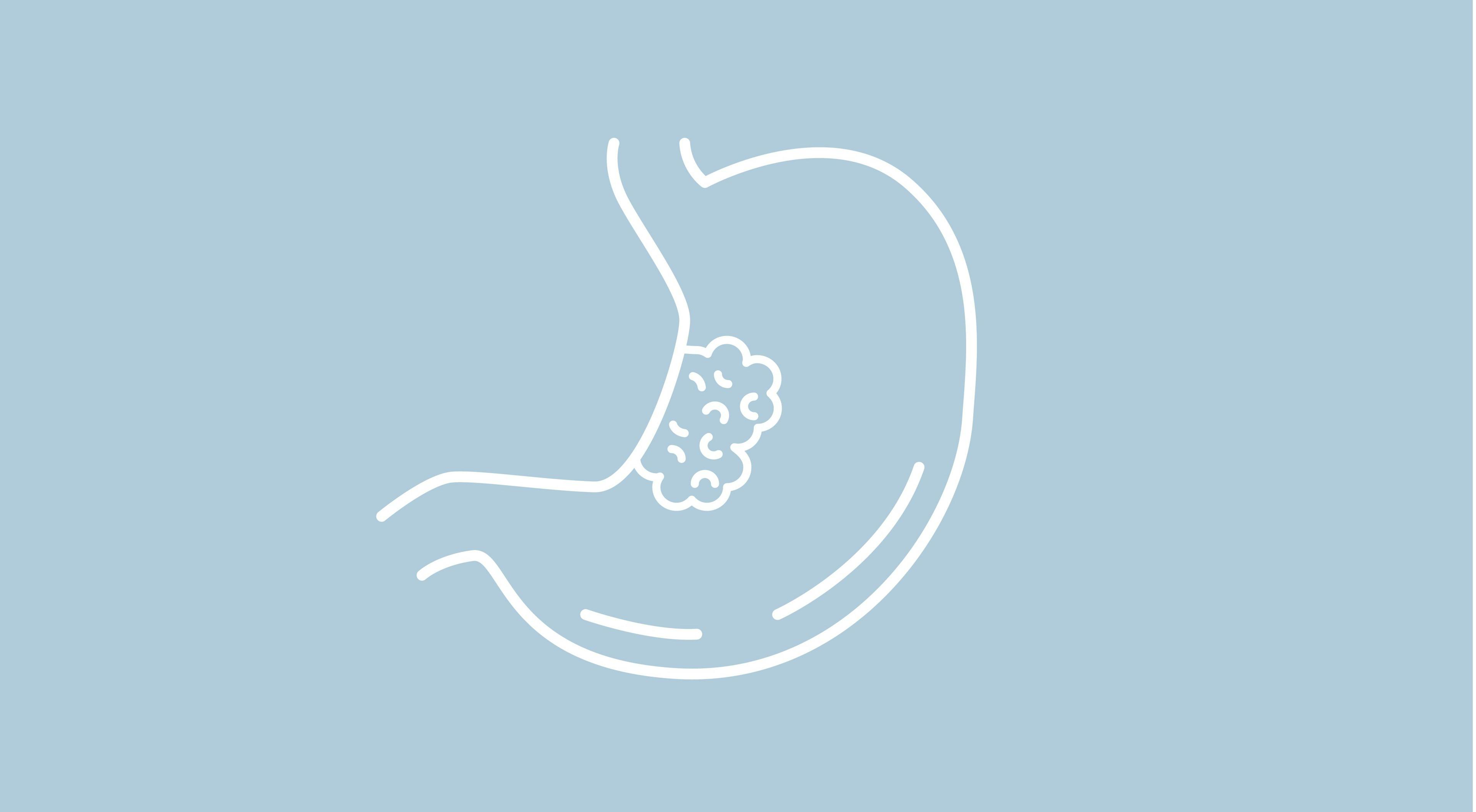 The Link Between Gastric Ulcers and Stomach Cancer