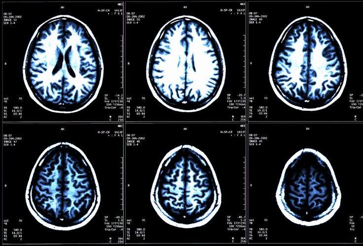 Brain Imaging Oncology Nursing News