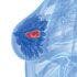 Orientation Eases Stress and Helps Breast Cancer Patients Manage Neoadjuvant Regimens