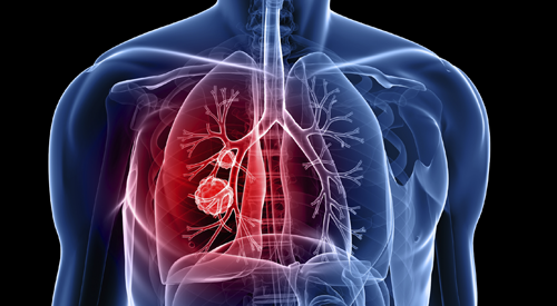 Osimertinib May Change Standard of Care for Stage III EGFR+ NSCLC After Definitive Chemoradiation