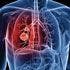 Study Sheds More Light on Link Between Prior Respiratory Disease and Lung Cancer