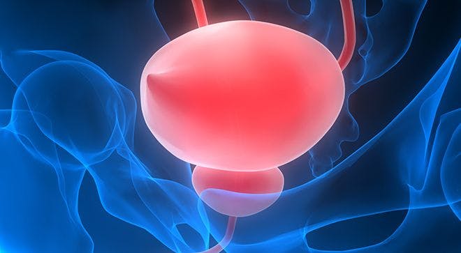 Localized Bladder Cancer Treatment Continues to Change: Expert Weighs In