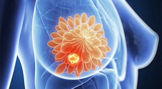 MONALEESA-3 Data Highlight Ribociclib as Standard in HR+ Breast Cancer