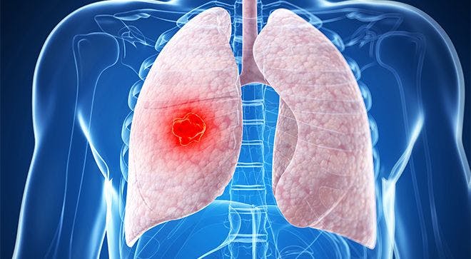 FDA Accepts sBLA for Frontline Atezolizumab Plus Carboplatin/Nab-Paclitaxel in Nonsquamous NSCLC