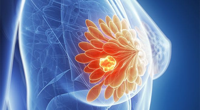 Biomarkers, PARP Inhibitors Key to Developing Triple-Negative Breast Cancer Treatments