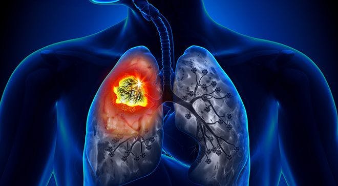 Immunotherapy for Small Cell Lung Cancer: Expert Provides Updates