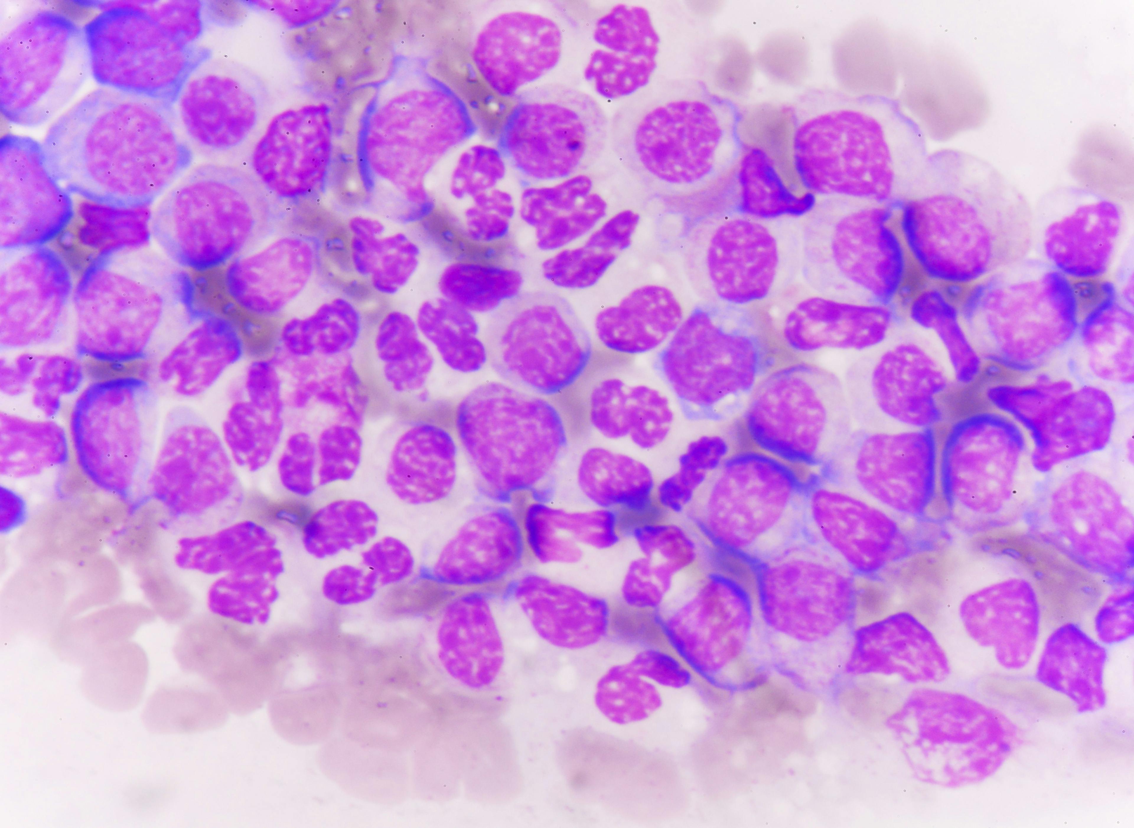Acute Myeloid Leukemia 