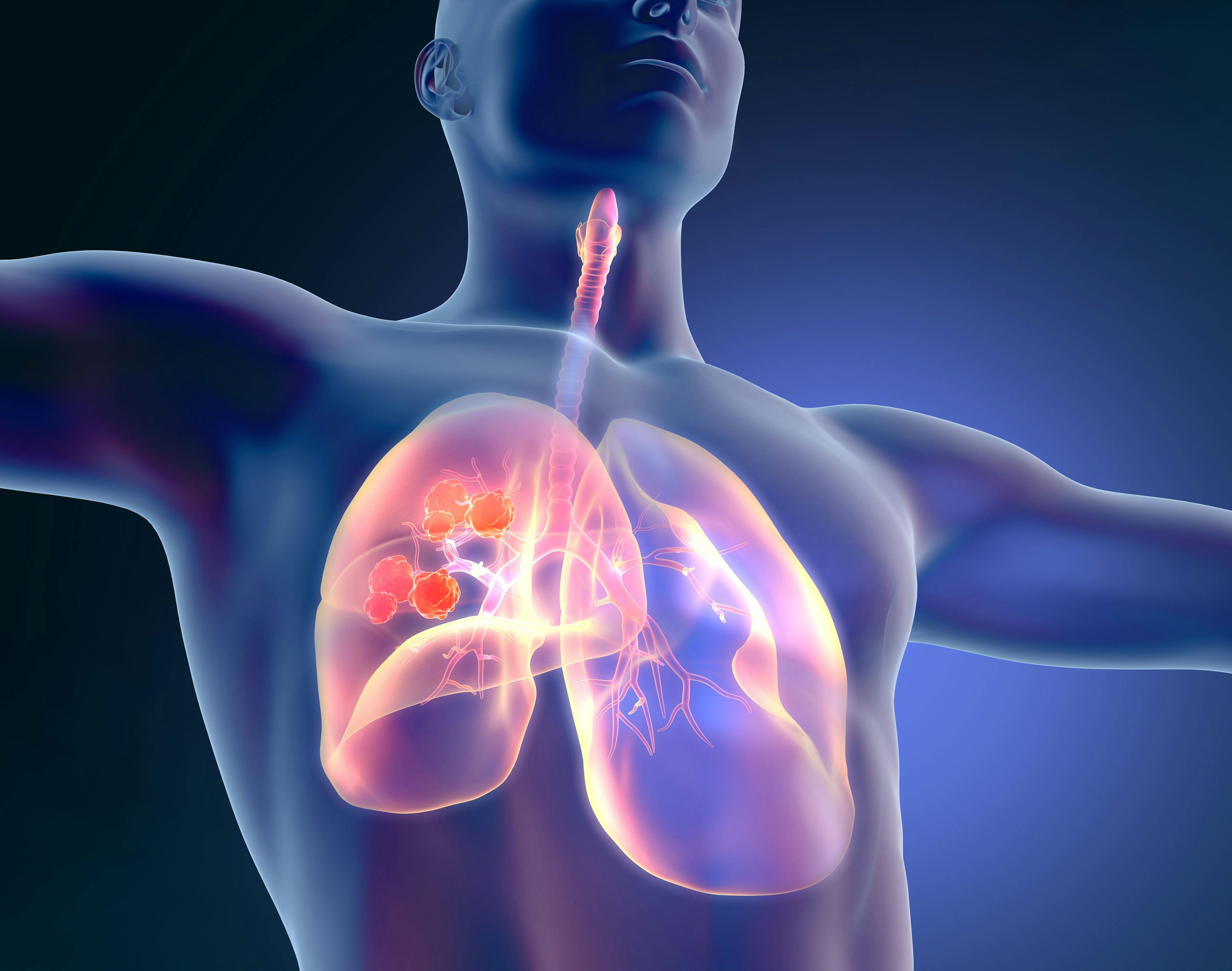 Targeted Therapies Move Forward in Oncogene-Driven Lung Cancer