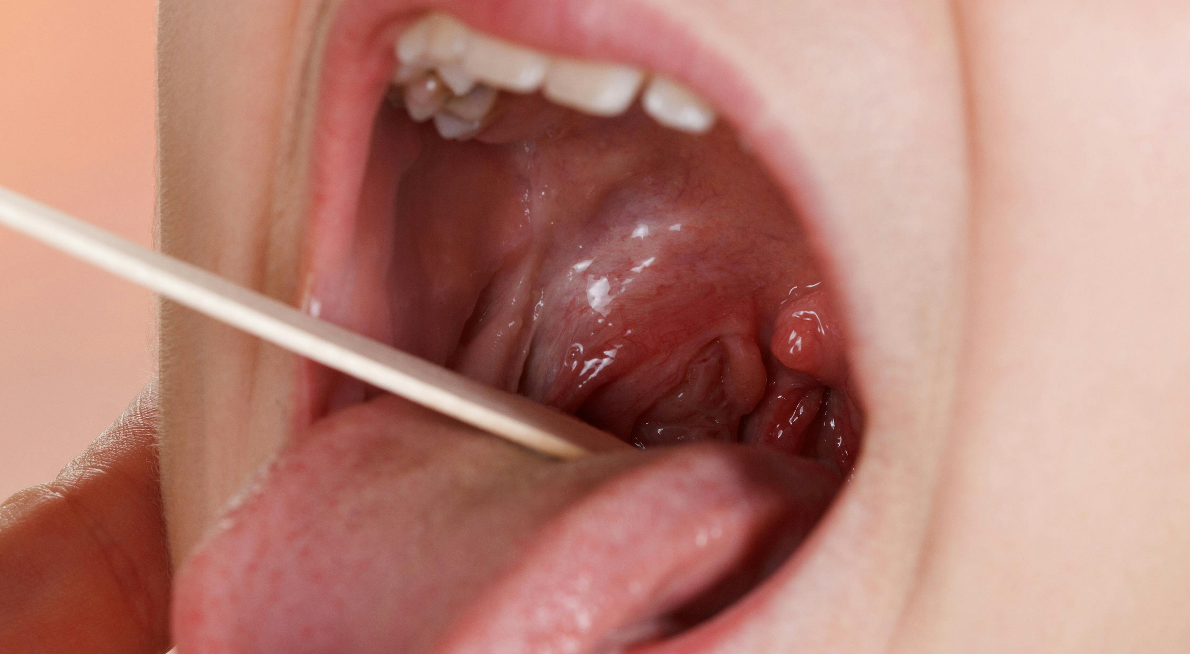 New Guidelines Published for Oral Mucositis Relief