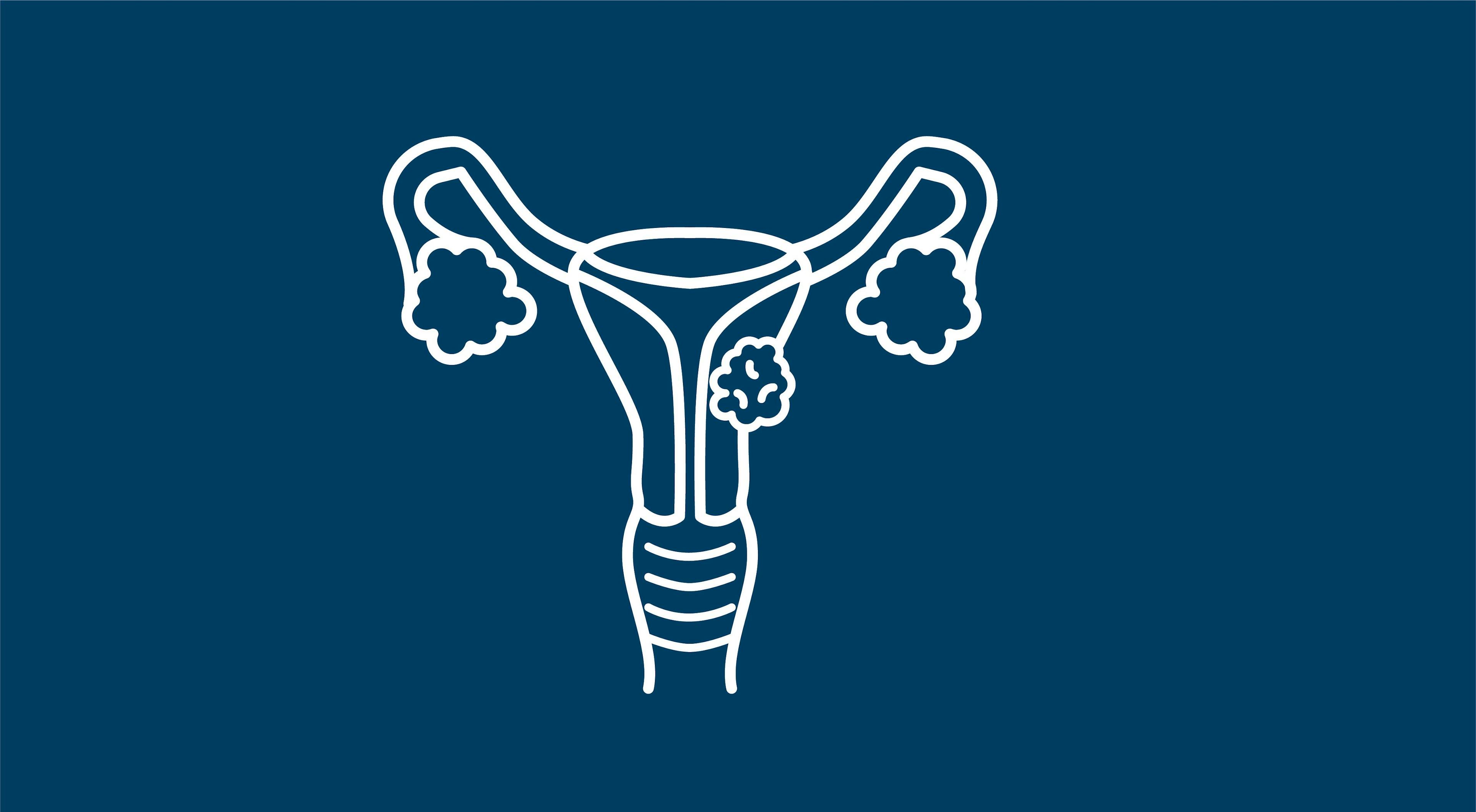 HRD, BRCA Status May Inform PARP Inhibitor Suitability in Advanced Ovarian Cancer