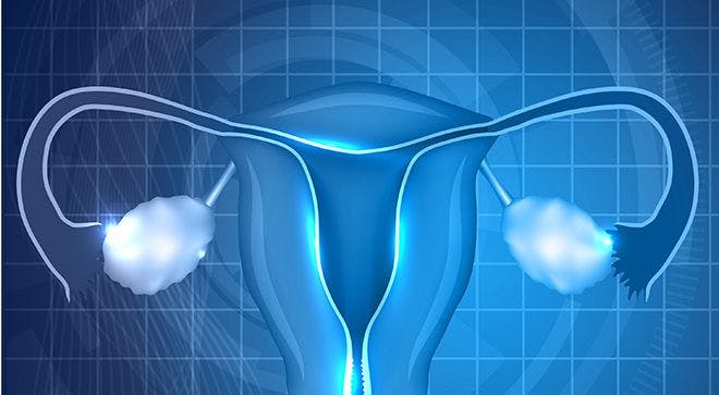 Olaparib Significantly Improves PFS in Advanced BRCA+ Ovarian Cancer