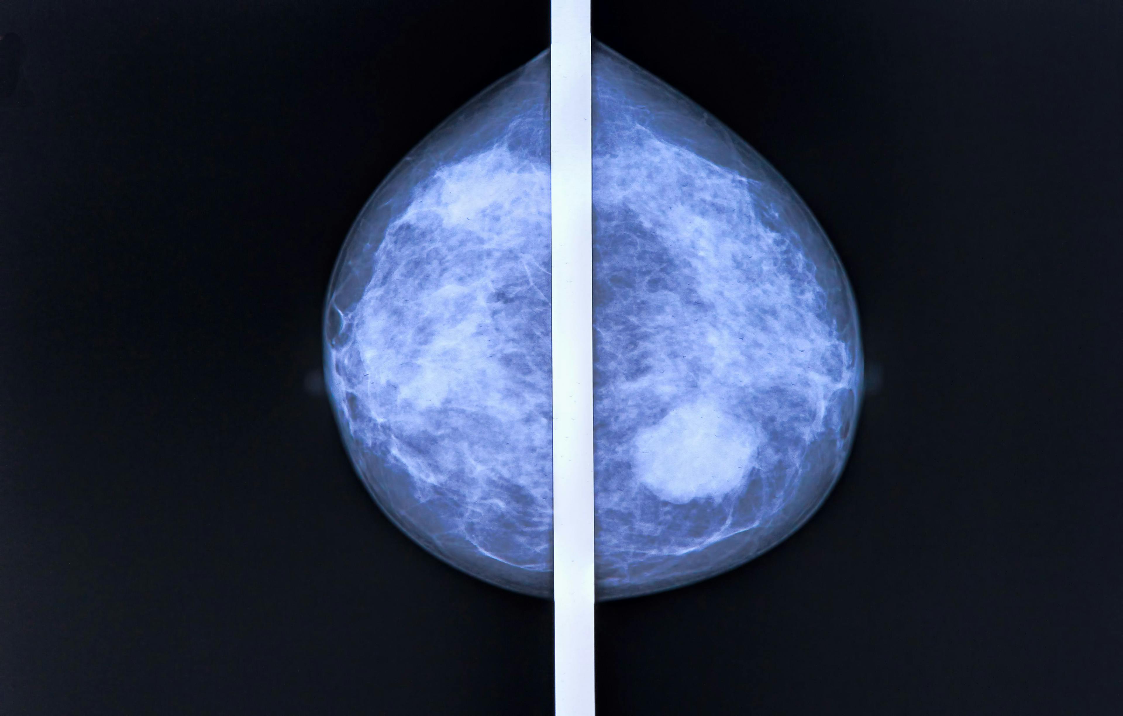 CDK4/6 Inhibitors Gain Momentum in Early-Stage Breast Cancer, But More Research is Still Needed