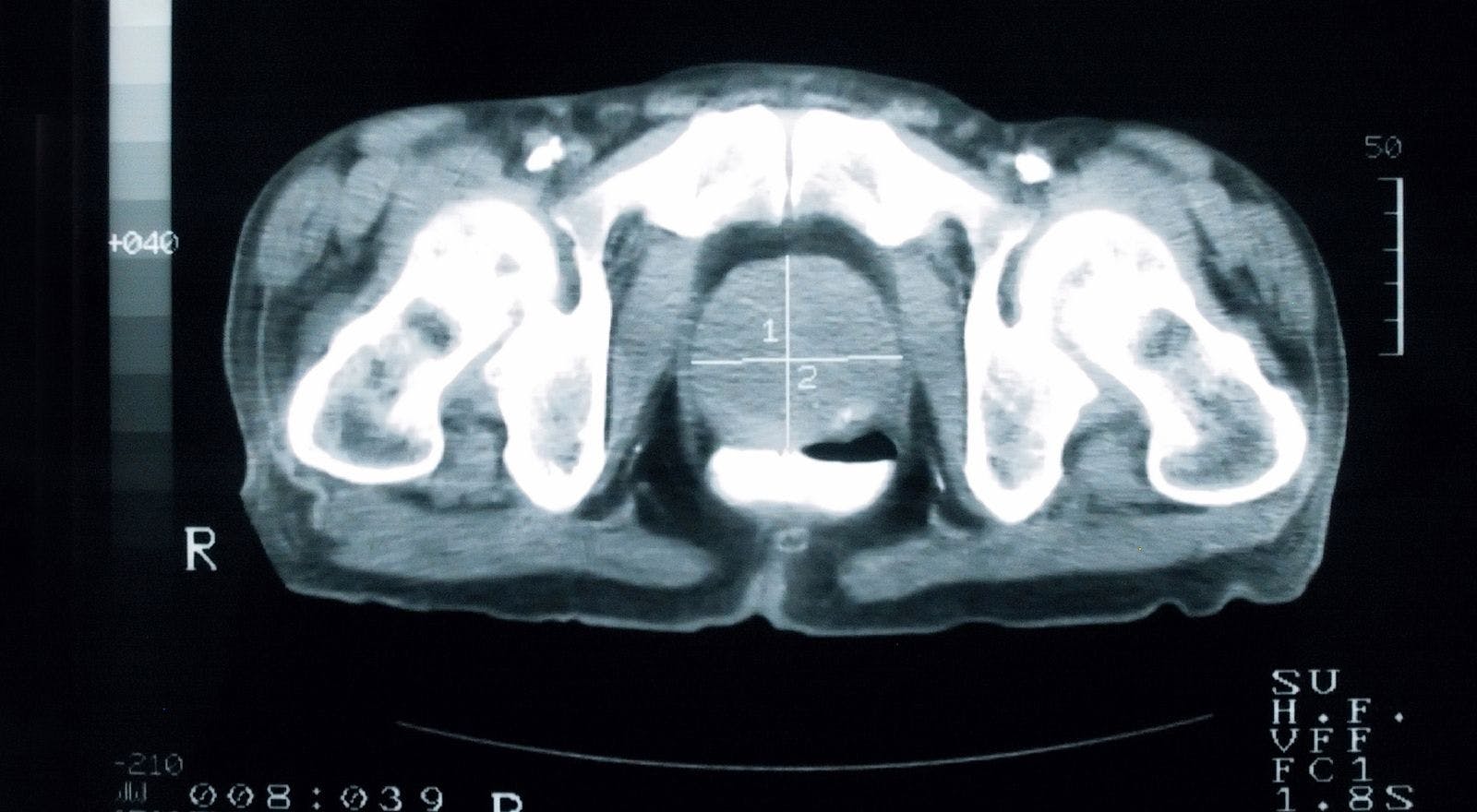 Next-Generation Imaging Will Change Prostate Cancer Paradigm