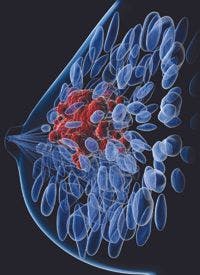Olaparib Improves Survival in BRCA-Positive Metastatic Breast Cancer