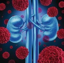 Post-Nephrectomy Patients with RCC Show Improved DFS with Adjuvant Pembrolizumab 
