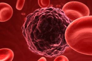 Addition of Polatuzumab Vedotin to R-CHP Reduces Risk of Disease Progression, Death in DLBCL