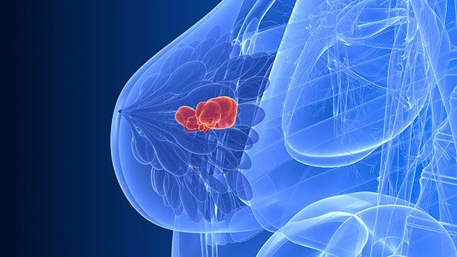 OS Benefit is Shown in CDK4/6 Inhibitors for Metastatic HR+ Breast Cancer