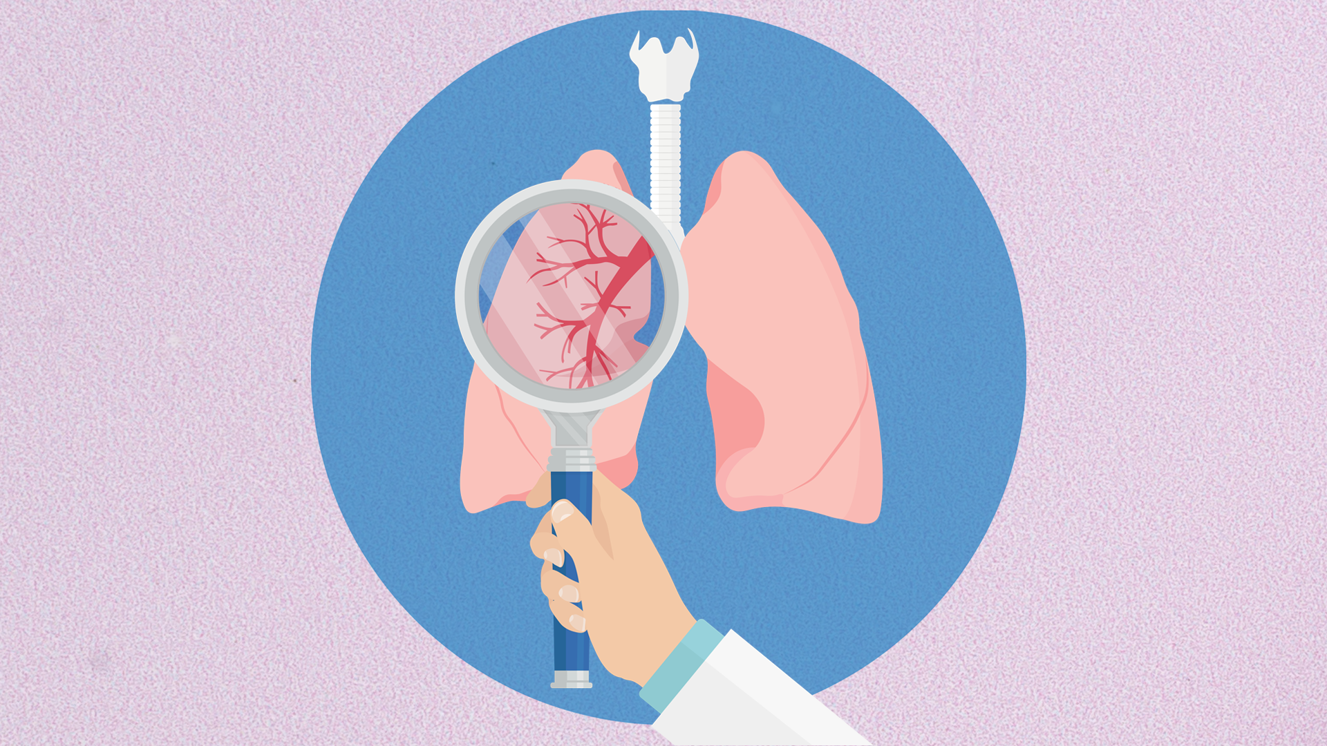 How I Counsel Patients About Lung Cancer Screening
