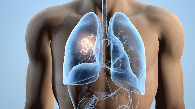 Upfront 4-Drug Regimen Is Tolerable in Lung Cancer Treatment