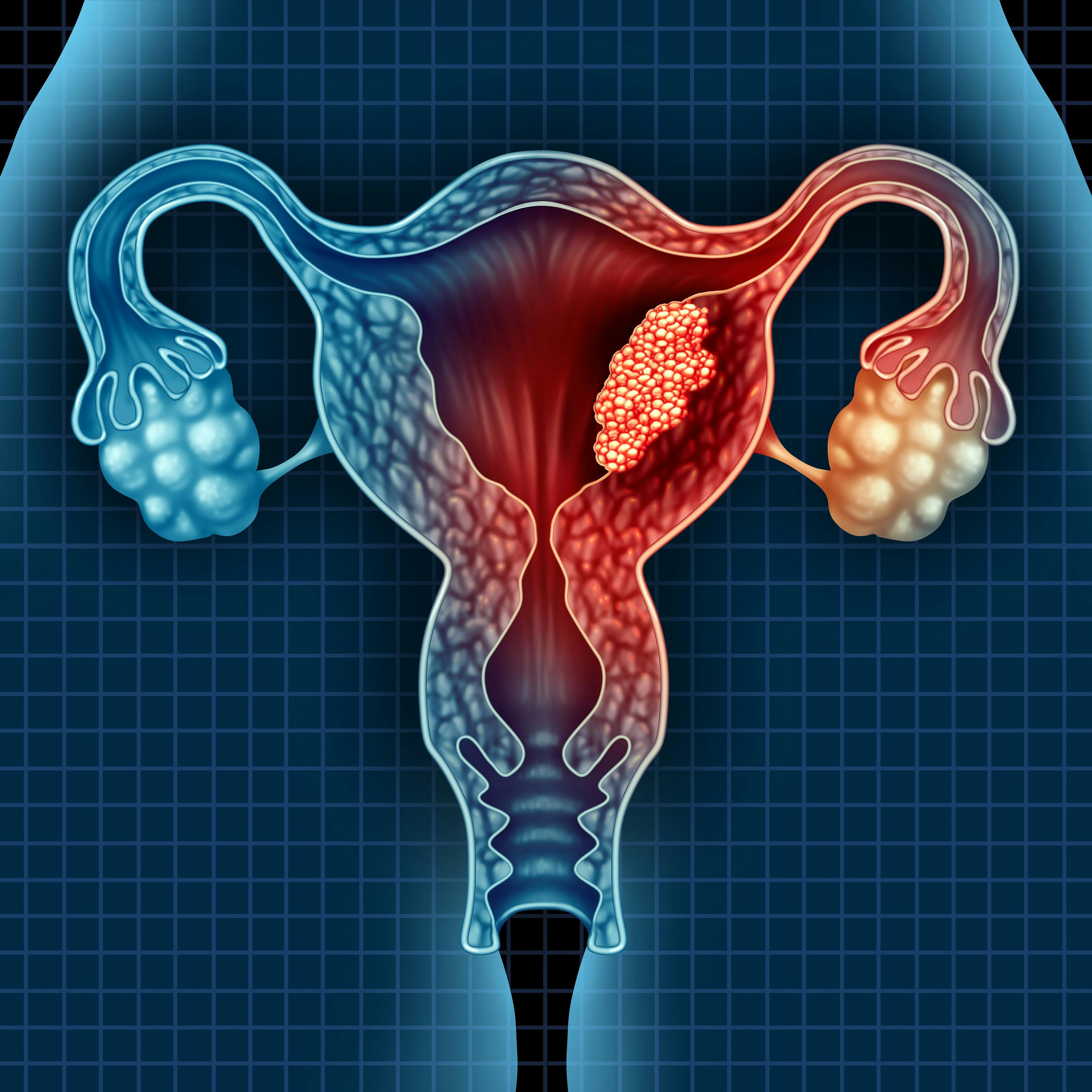Uterus Cancer: © freshidea - stock.adobe.com