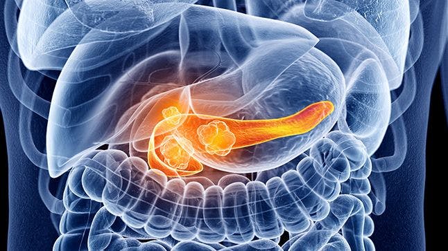PARP Inhibitors Hit the Pancreatic Cancer Scene