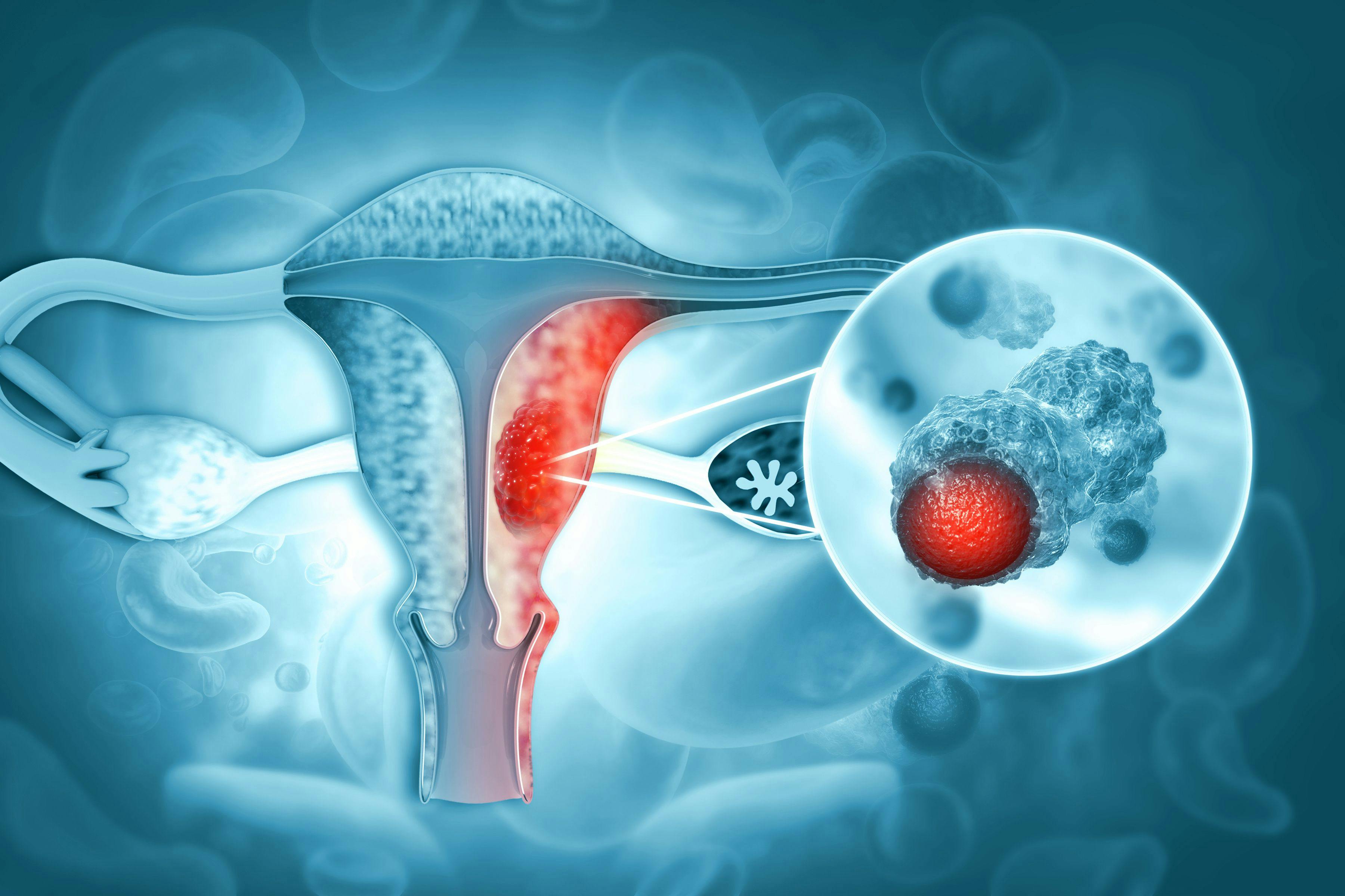 Female reproductive system diseases.uterus cancer and endometrial malignant tumor as a uterine medical concept.3d illustration | Image Credit: © Crystal light - stock.adobe.com