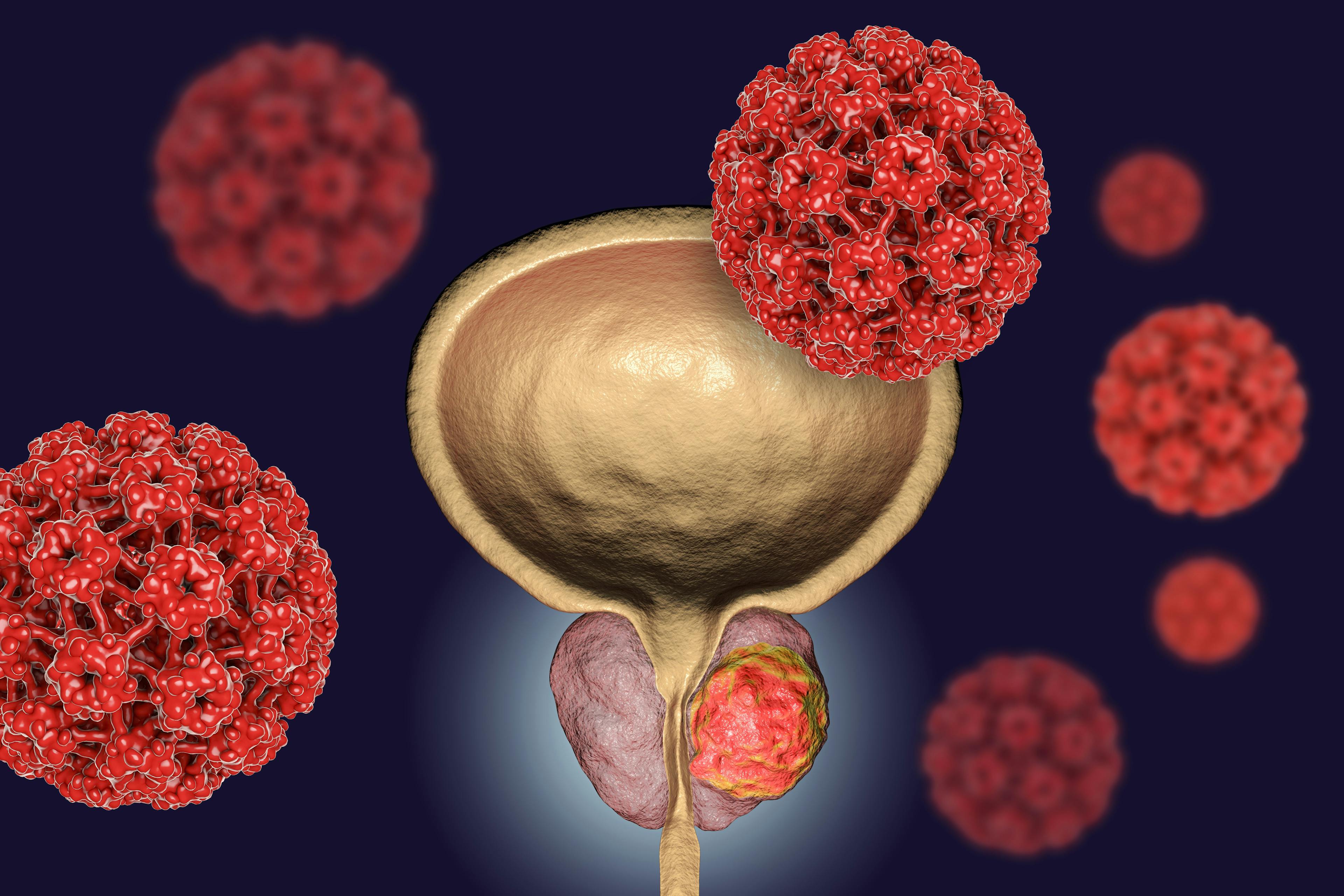 Adjuvant Radiation Therapy Associated with Reduced Risk of Death in High-Risk Prostate Cancer