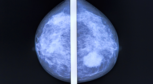Variations in Diagnostic Mammograms Emphasizes Need for Racially and Ethnically Diverse Performance Studies