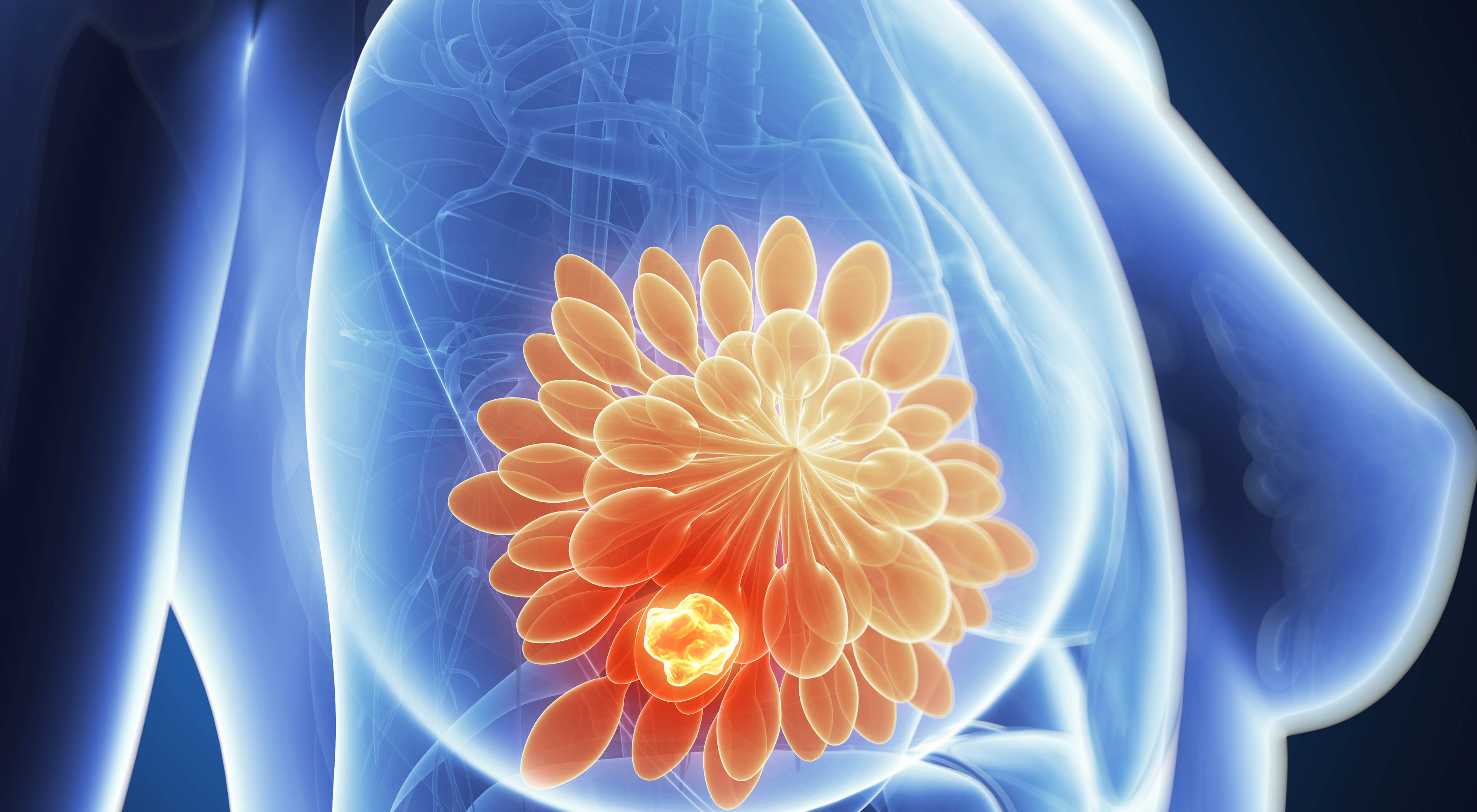 Sacituzumab Govitecan Significantly Prolongs Overall Survival in Patients With HR+/HER2- Metastatic Breast Cancer