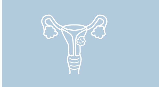 uterine carcinoma 
