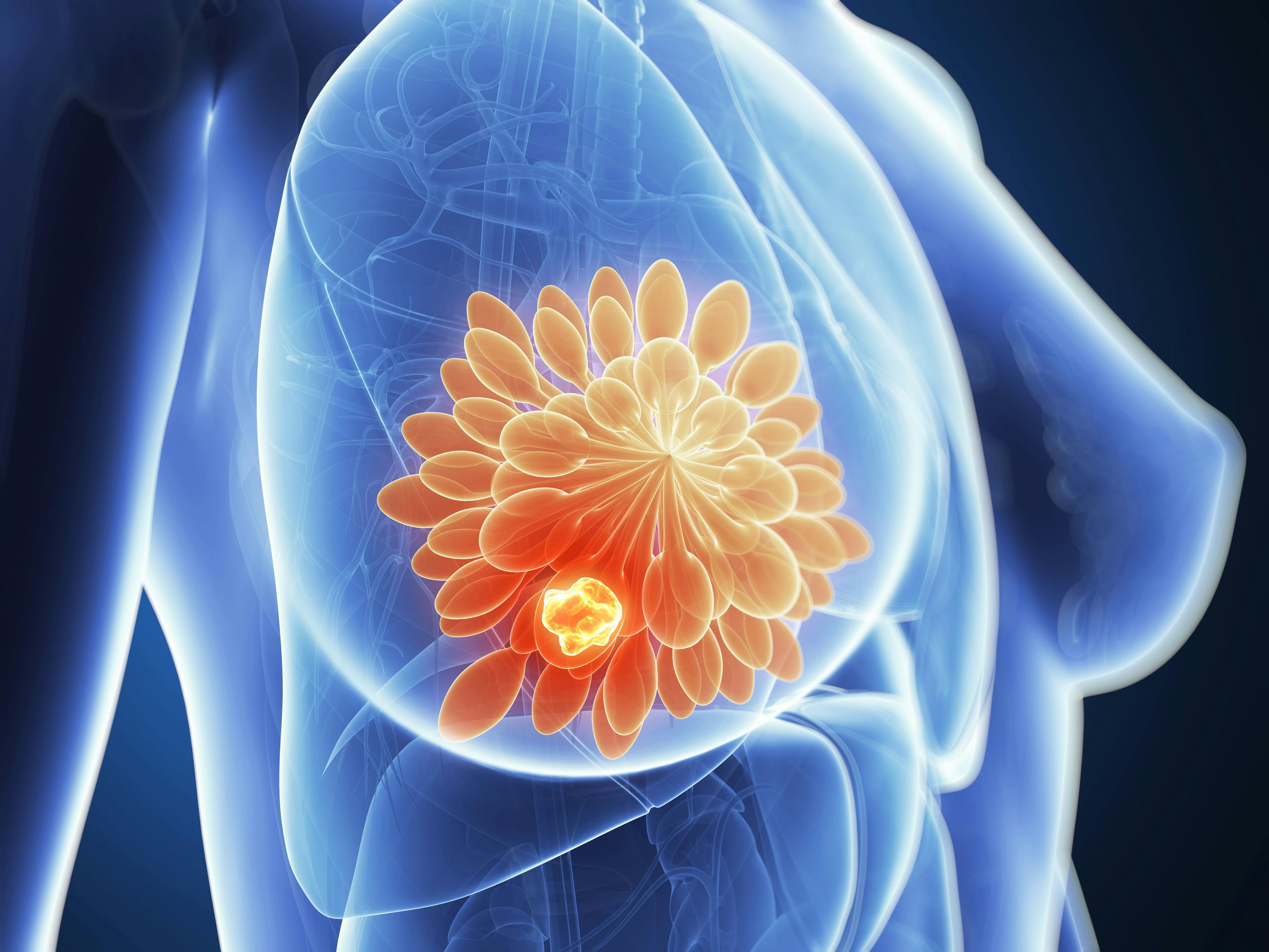 Breast Cancer Image