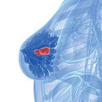 Partial Breast Irradiation as Effective as Conventional Therapy