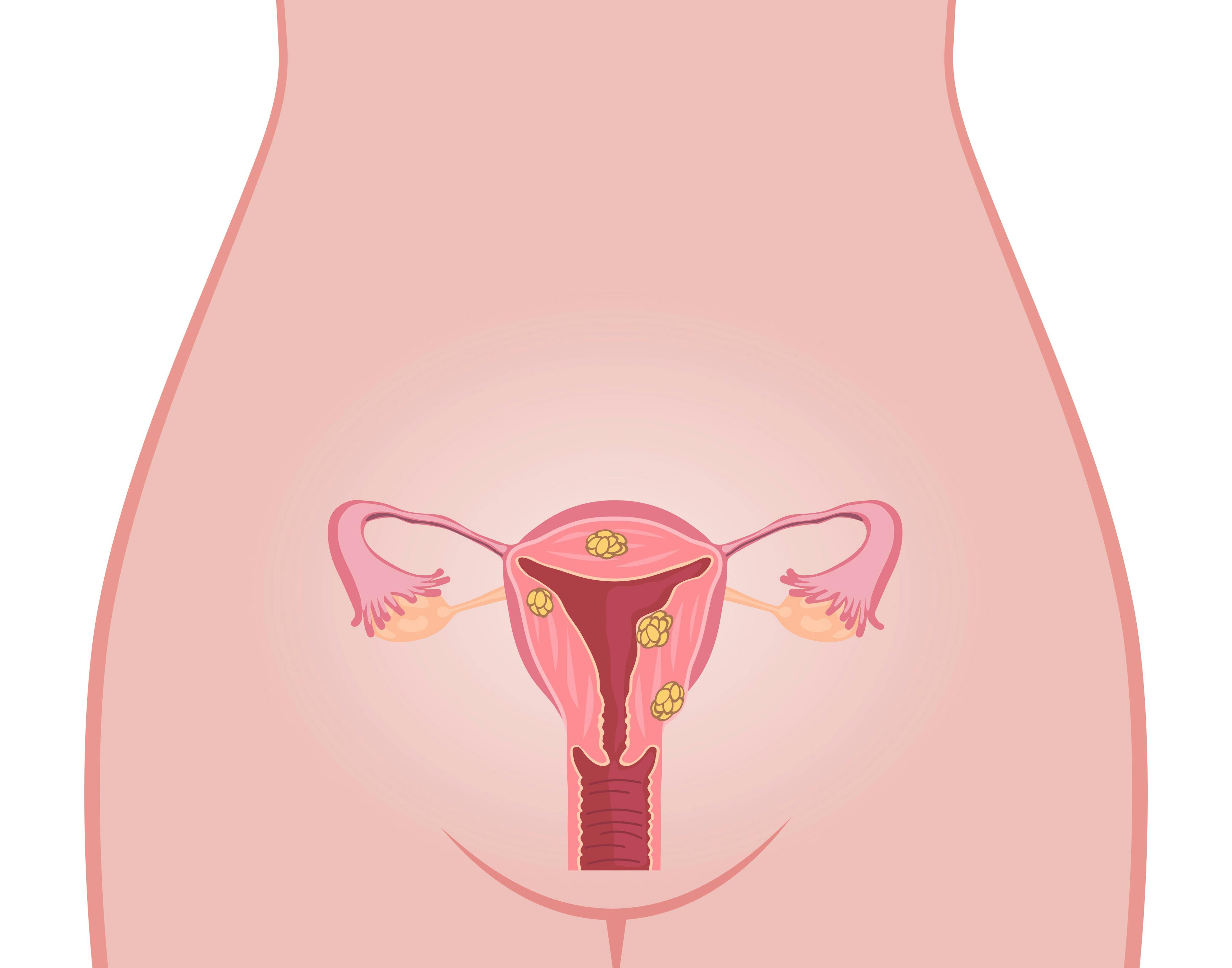 Checkpoint Blockade Drives Progress in Endometrial Cancer Treatment