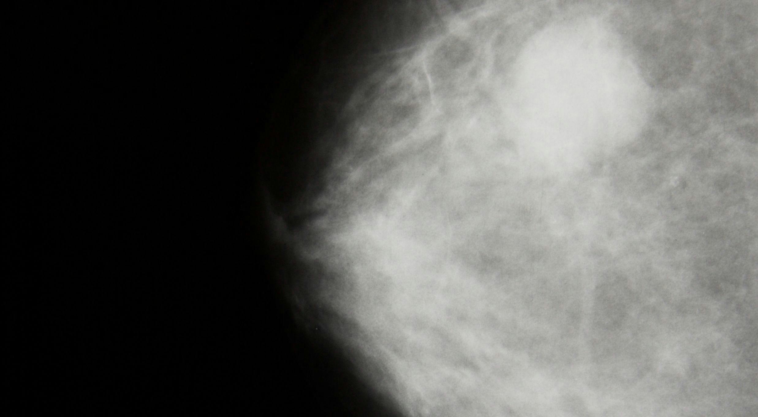 Radiation's Role Shifts in Breast Cancer