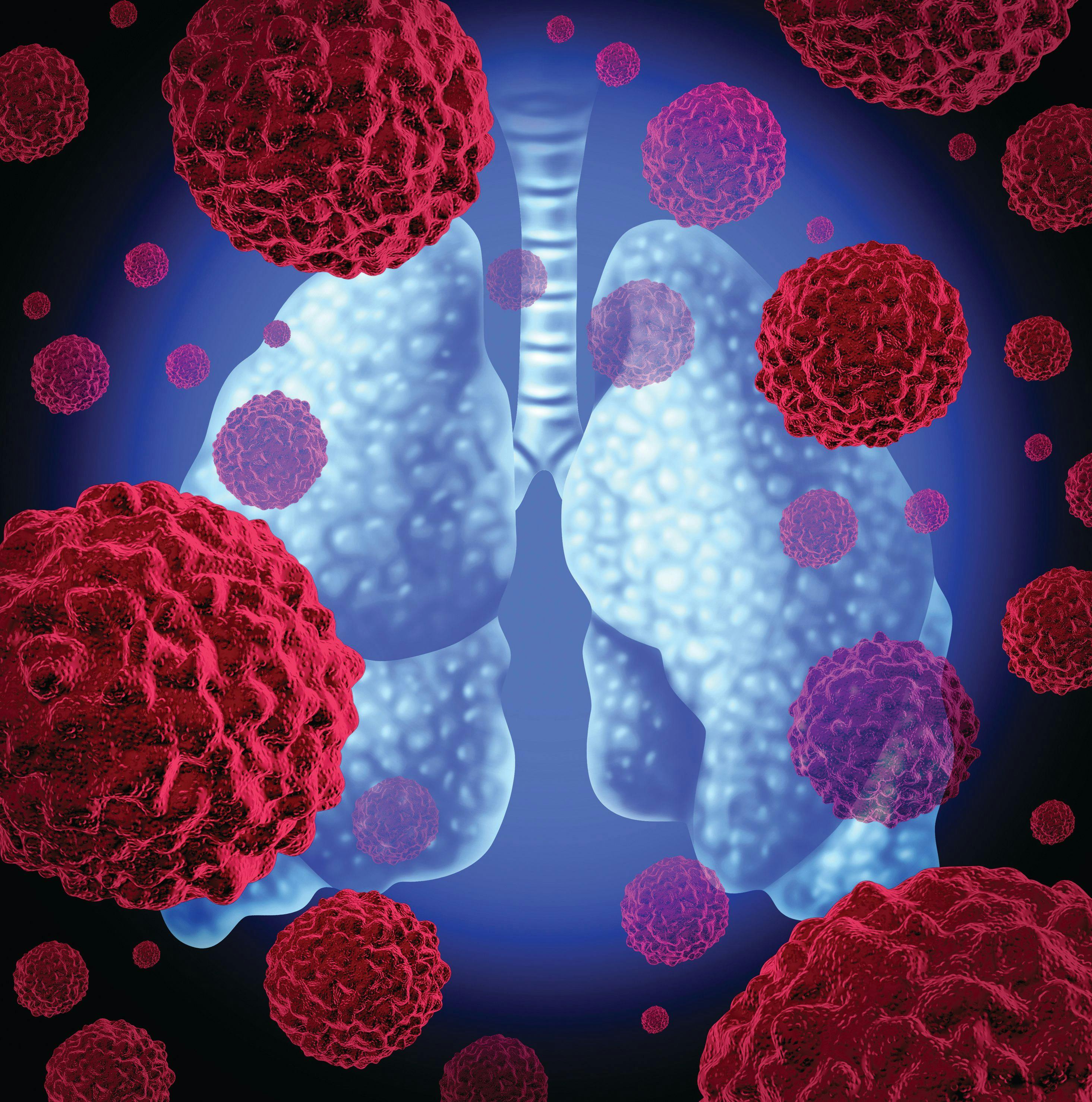  Pralsetinib Is Tolerable, Durable in RET Fusion+ NSCLC