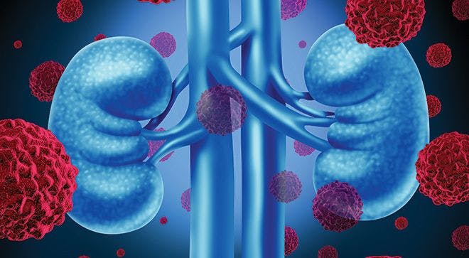 Renal Cell Carcinoma Treatment Evolves as New Therapies are Approved