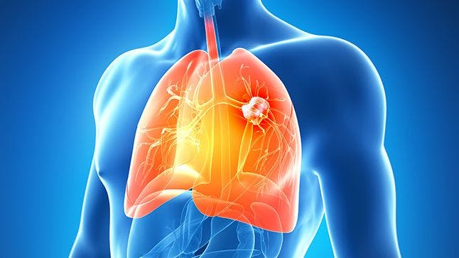 Immunotherapy Combos in Advanced Nonsquamous NSCLC: What Does the Data Say?