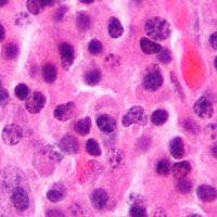 Daratumumab Approved Early by FDA for Multiple Myeloma
