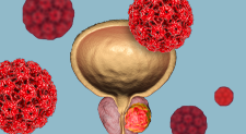 Metastatic Urothelial Cancer Treatments Continue to Gravitate Towards Immunotherapy and Targeted Therapies 