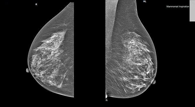 NCCN Guidelines on Breast Cancer Impact Clinical Applications of Radiation Therapy