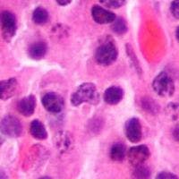 Pembrolizumab Triplet Therapy Beneficial for Patients With Pretreated Myeloma