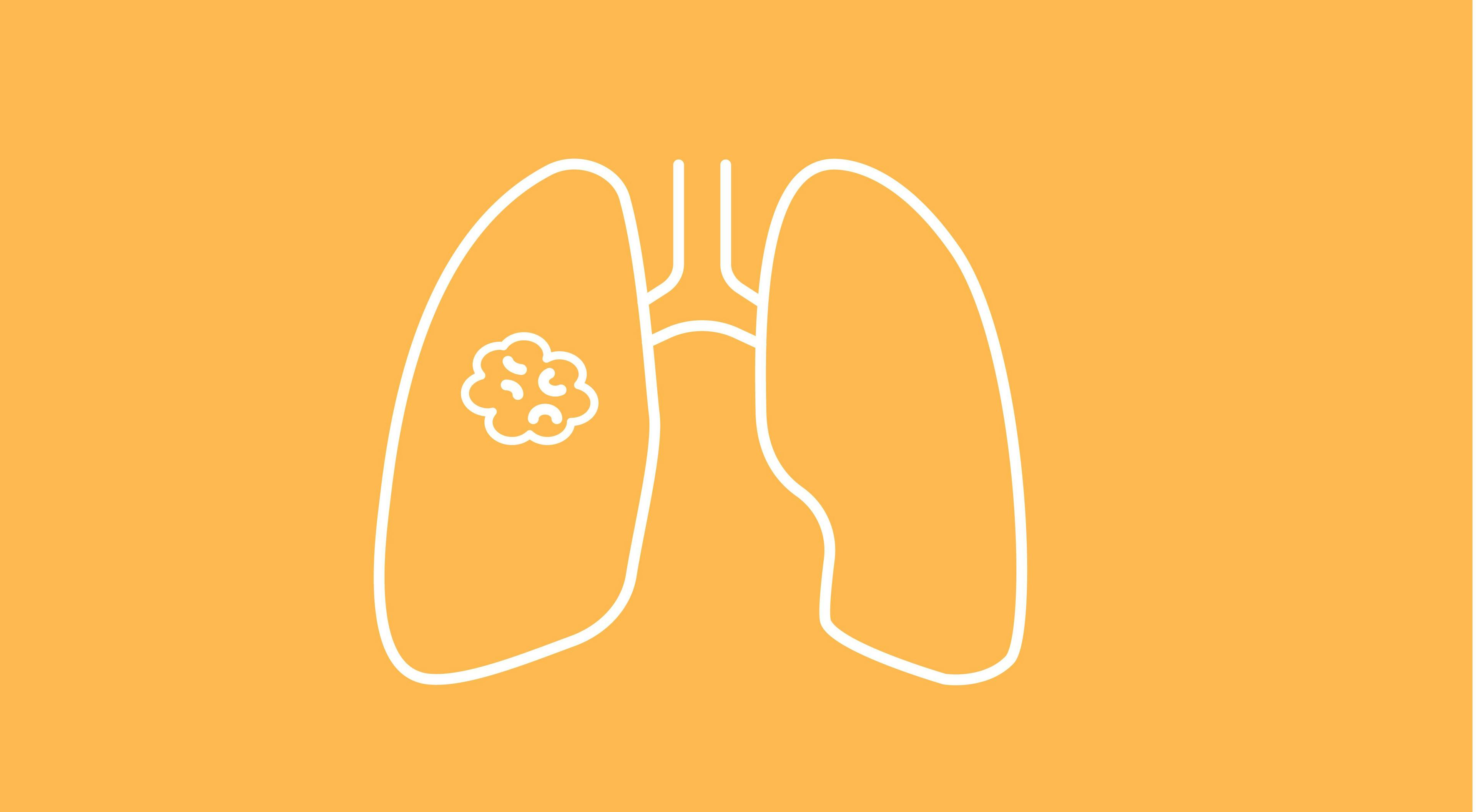 Trilaciclib Snags ASCO Recommendation in Extensive-Stage Small Cell Lung Cancer