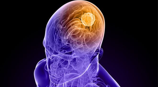 New Combo May Treat Rare Brain Tumor