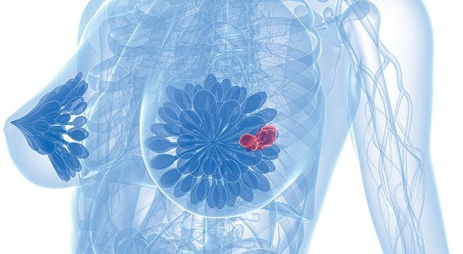 PFS Improves with Talazoparib Use in BRCA-Positive Breast Cancer